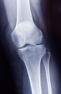 Röntgenbild Kniegelenk