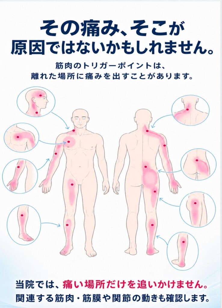 筋肉のトリガーポイントから離れた場所に痛みが現れる関連痛を、全身図で示したイラスト