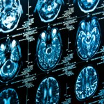 レントゲンで異常がない膝痛が増えている