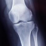 中高年の膝の痛みに対する関節鏡手術の効果はわずかしかない