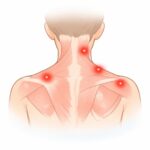 筋膜性疼痛症候群（MPS）とは？原因と改善の考え方をやさしく解説