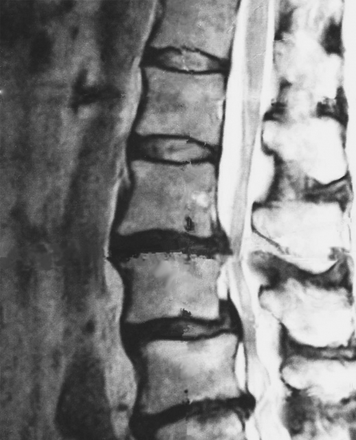 椎間板ヘルニア、脊柱菅狭窄症＝痛みではない