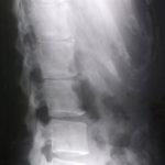 腰椎分離すべり症と痛み