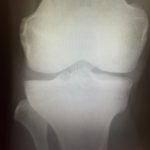 変形性膝関節症と痛み