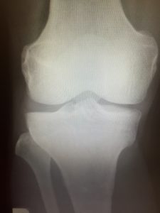 変形性膝関節症と痛み