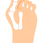 外反母趾 ― 痛みの原因は「骨の変形」だけではありません