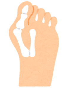 外反母趾 ― 痛みの原因は「骨の変形」だけではありません