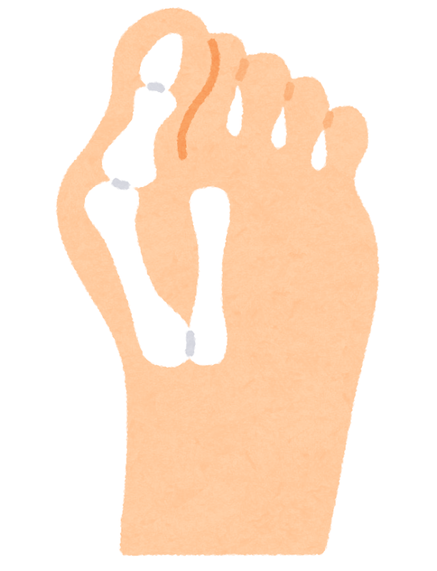 外反母趾 ― 痛みの原因は「骨の変形」だけではありません