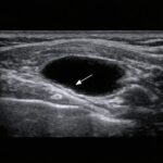 膝の裏が痛い原因｜歩くと痛い・曲げると痛い膝裏の痛み